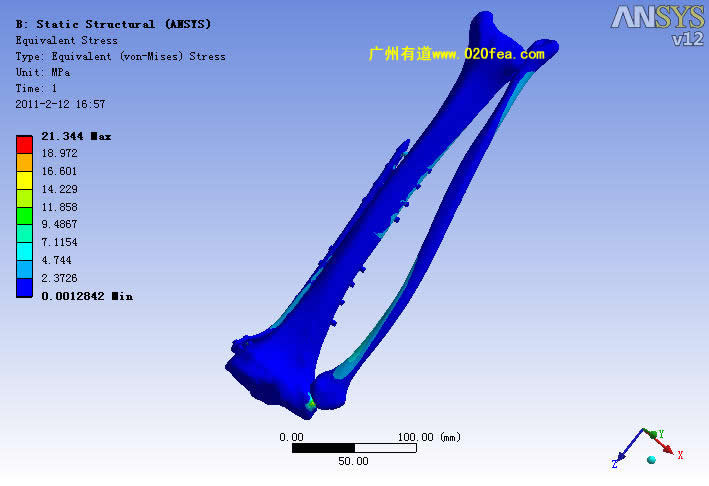 骨科有限元 医学有限元分析 骨科有限元 医学有限元分析